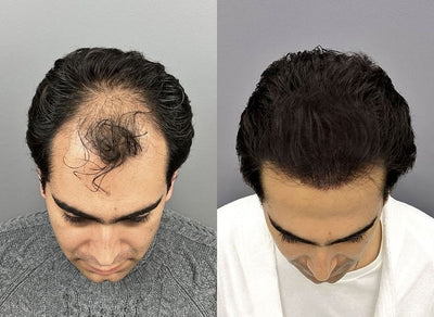Cheveux plus denses c'est fou